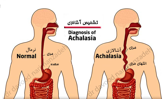 آشالازی - درمان آشالازی - جراحی لاپاراسکوپی آشالازی