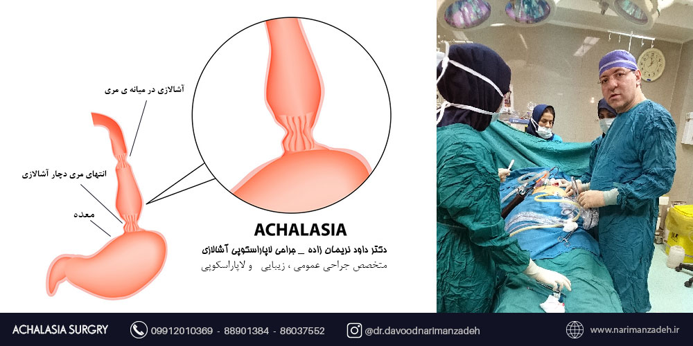 آشالازی - درمان آشالازی - جراحی لاپاراسکوپی آشالازی