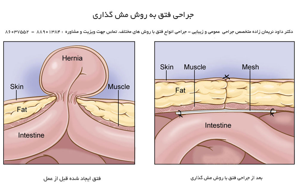 بهترین جراح فتق