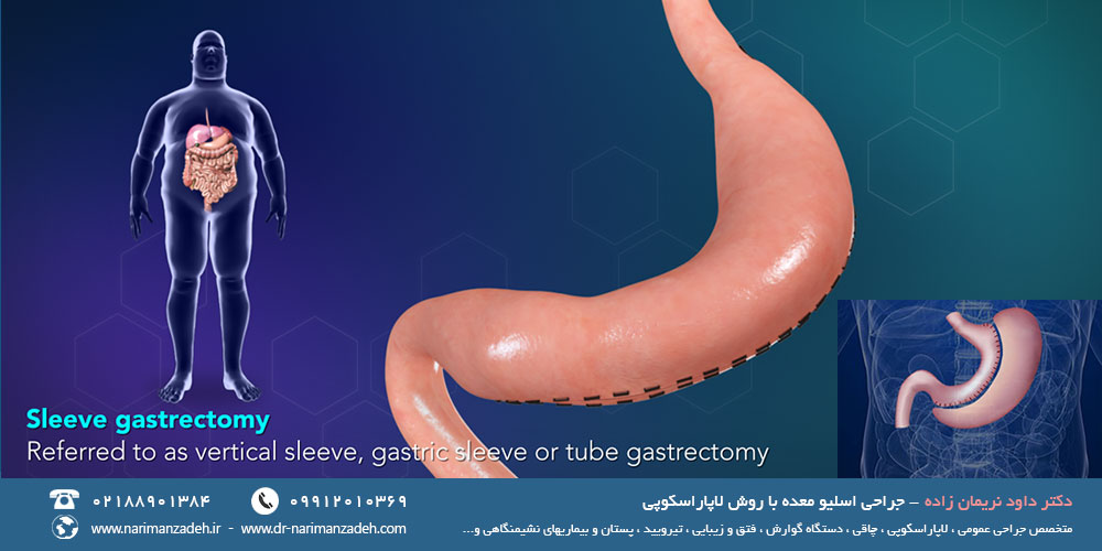 بهترین جراح اسلیو معده