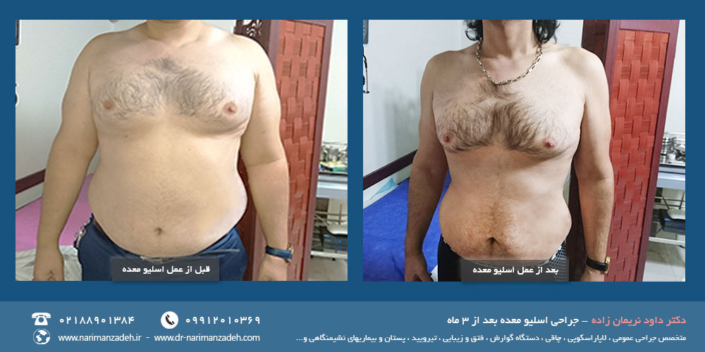 بهترین جراح اسلیو معده