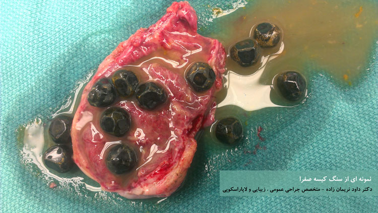 سنگ کیسه صفرا - جراحی کیسه صفرا - بهترین جراح کیسه صفرا 